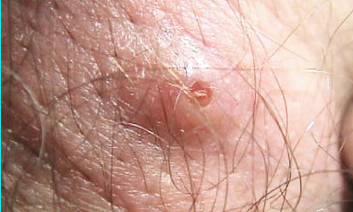 Raised lesion on the skin caused by the presence of a larva of the human bot fly, Dermatobia hominis (Linnaeus Jr.). 